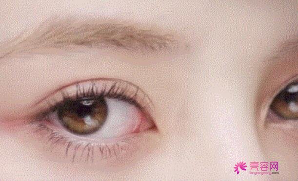 下眼至整形图片对比,秒变无辜眼:想拥有漫画版“小鹿眼”吗?