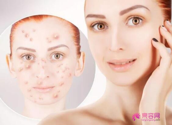 碘伏可以涂在痘痘上吗?去除痘痘的办法都有那些呢?祛痘医美项目