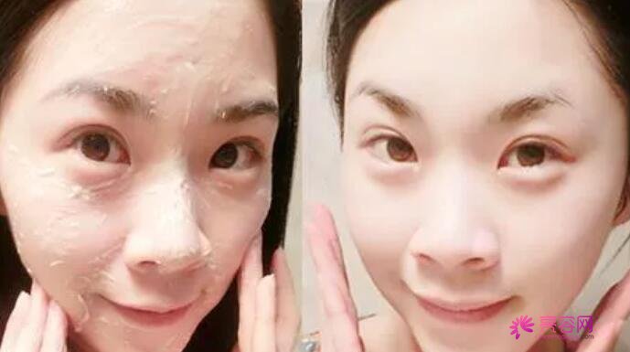 碘伏可以涂在痘痘上吗?去除痘痘的办法都有那些呢?祛痘医美项目