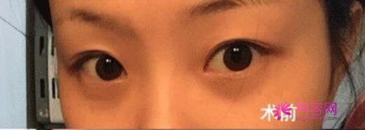 西安唯星颜医疗美容好不好？吴珊珊医生好不好？双眼皮案例来袭~