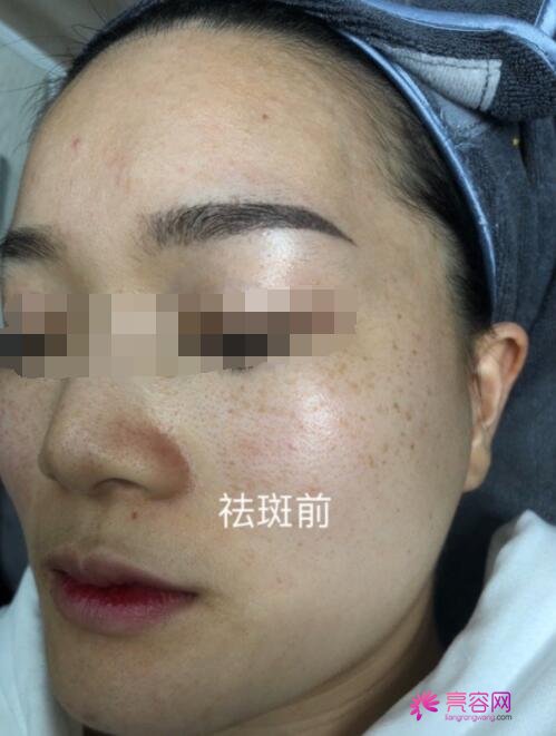 祛斑较好的方法目前较有的是什么呢?激光祛斑没问题吗?