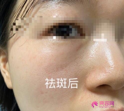 祛斑较好的方法目前较有的是什么呢?激光祛斑没问题吗?