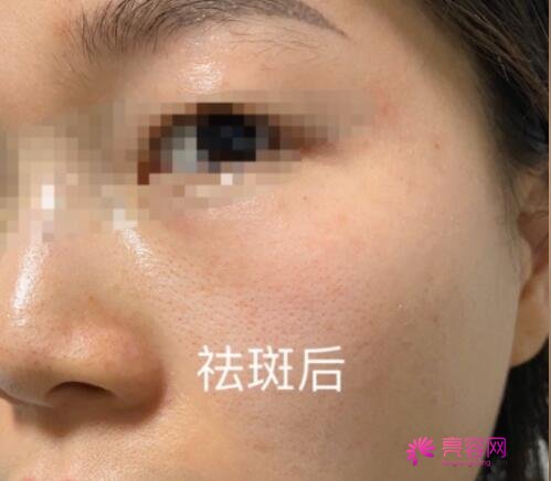 祛斑较好的方法目前较有的是什么呢?激光祛斑没问题吗?