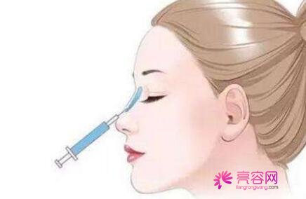 冯雁平医生做隆鼻技术怎么样?医生技术口碑评价+隆鼻案例