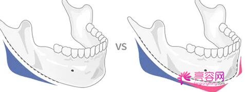 韩国卢相勋整形外科卢相勋技术怎么样?医生简介+下颌角磨骨案例