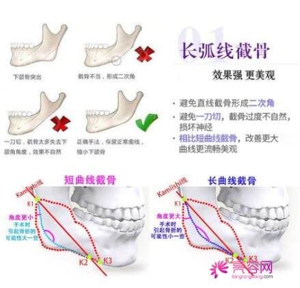 韩国卢相勋整形外科卢相勋技术怎么样?医生简介+下颌角磨骨案例