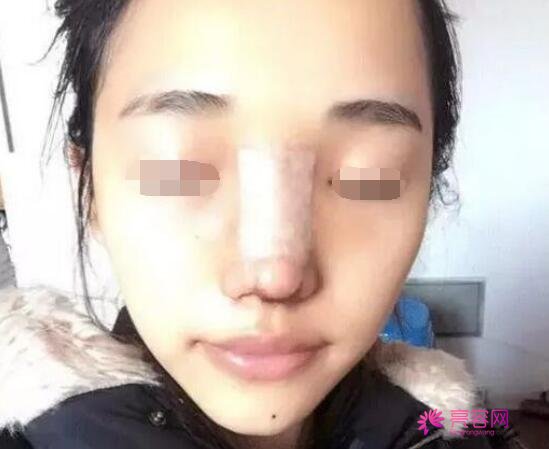 昆明大华整形美容医院怎么样?口碑整形医院+隆鼻手术真人果反馈