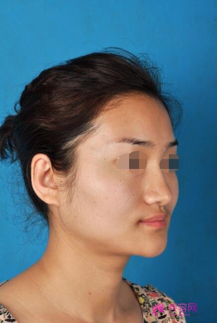 下颌角整容手术好吗？术后该怎么护理呢？真人做下颌角整形案例果