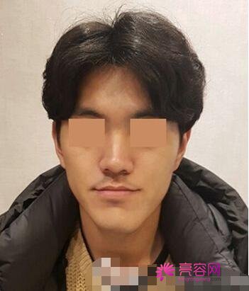 男性过大下颌角整形果好不好?来看手术前后变化:真的值得一做?