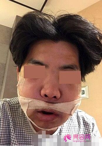 男性过大下颌角整形果好不好?来看手术前后变化:真的值得一做?