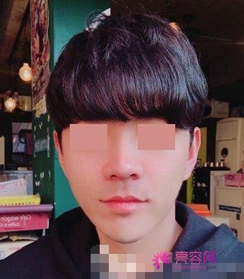 男性过大下颌角整形果好不好?来看手术前后变化:真的值得一做?