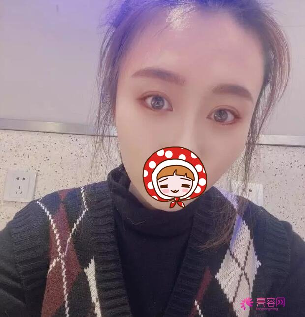 下眼至整形图片对比,秒变无辜眼:想拥有漫画版“小鹿眼”吗?