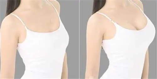 曼托妙桃假体隆胸果好吗?一起来了解一下