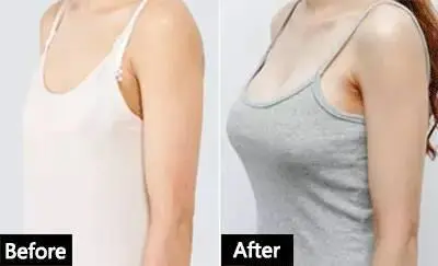 曼托妙桃假体隆胸果好吗?一起来了解一下