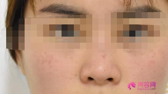 蒜头鼻整形前后对比照片分享！我用我的真实经历告诉你果好不好？