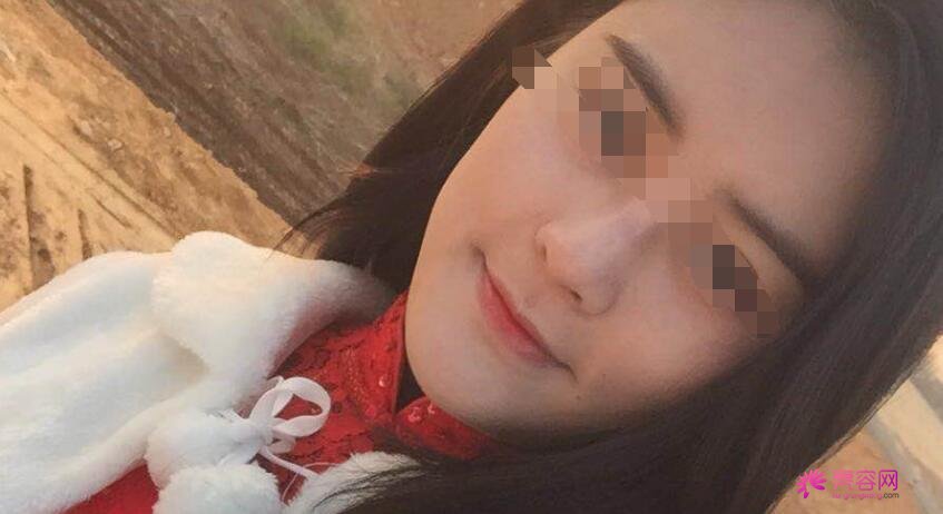 蒜头鼻整形前后对比照片分享！我用我的真实经历告诉你果好不好？