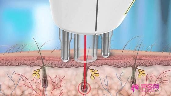 激光脱毛6年后后悔了原因是什么?激光脱毛是否有坏处?30秒带你了解