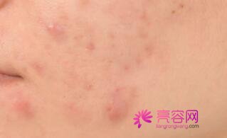 激光祛斑的危害与果你知道哪些?术后有什么注意事项吗?