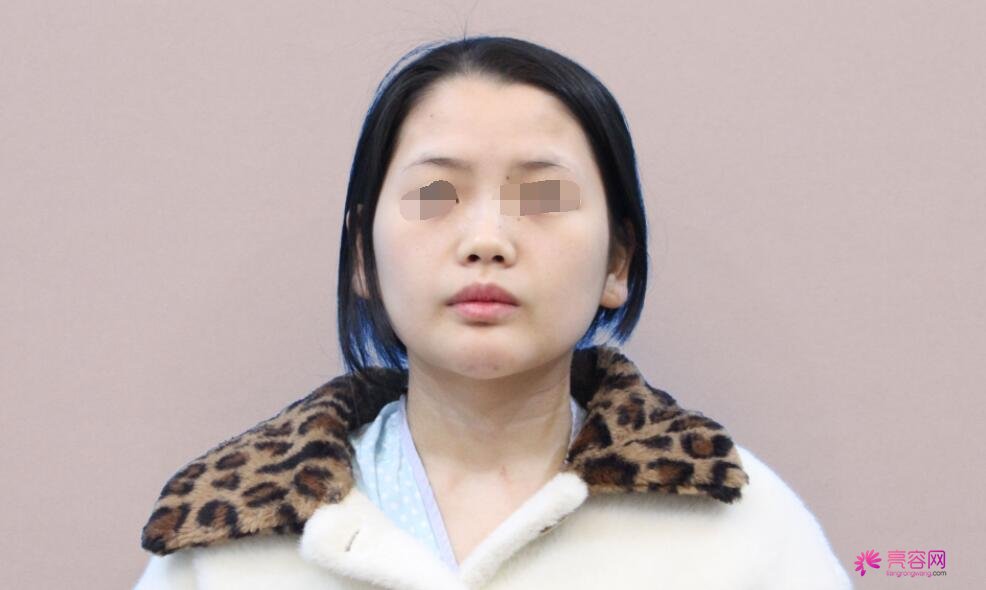 冯雁平医生做隆鼻技术怎么样?医生技术口碑评价+隆鼻案例