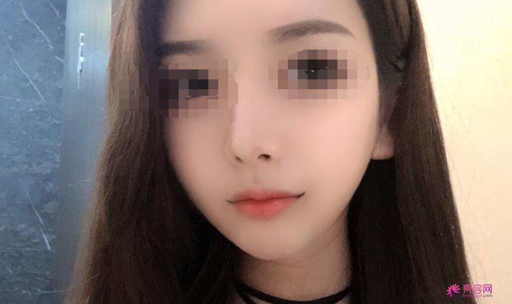 冯雁平医生做隆鼻技术怎么样?医生技术口碑评价+隆鼻案例