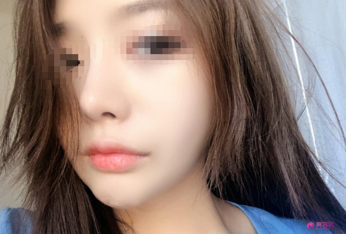 冯雁平医生做隆鼻技术怎么样?医生技术口碑评价+隆鼻案例