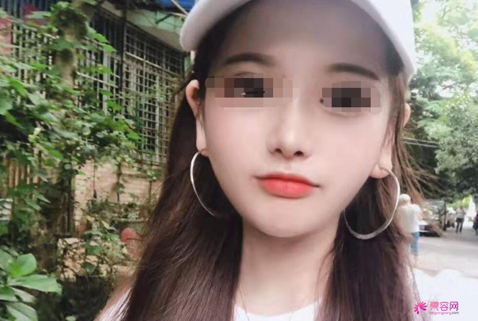 冯雁平医生做隆鼻技术怎么样?医生技术口碑评价+隆鼻案例