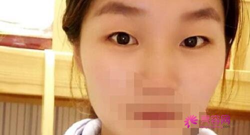 杭州艺星医疗美容医院李慧玲医生做双眼皮怎么样?双眼皮案例别错过!
