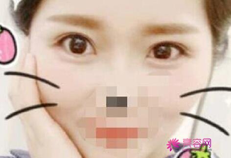 杭州艺星医疗美容医院李慧玲医生做双眼皮怎么样?双眼皮案例别错过!