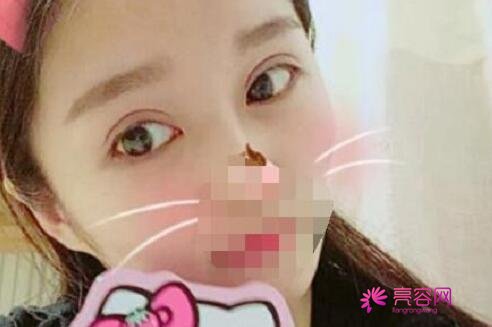 杭州艺星医疗美容医院李慧玲医生做双眼皮怎么样?双眼皮案例别错过!