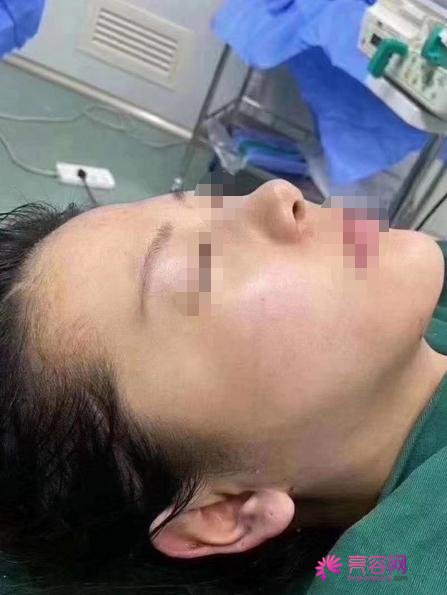 韩国卢相勋整形外科卢相勋技术怎么样?医生简介+下颌角磨骨案例