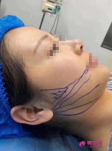 韩国卢相勋整形外科卢相勋技术怎么样?医生简介+下颌角磨骨案例