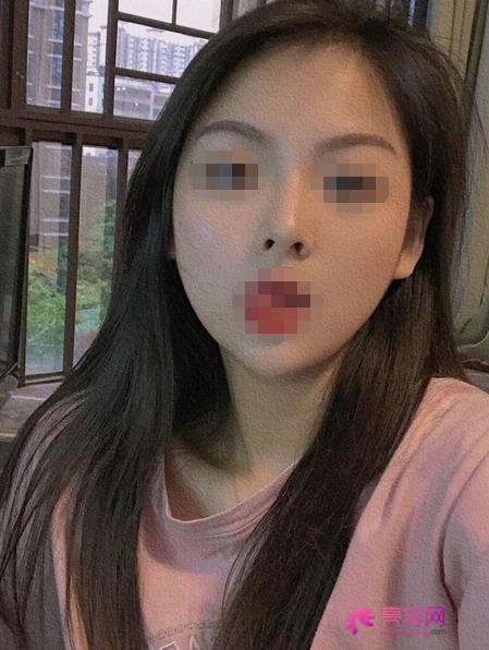 韩国卢相勋整形外科卢相勋技术怎么样?医生简介+下颌角磨骨案例