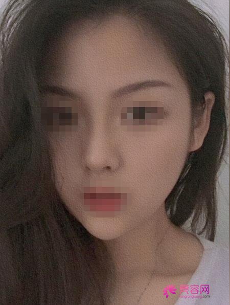 韩国卢相勋整形外科卢相勋技术怎么样?医生简介+下颌角磨骨案例