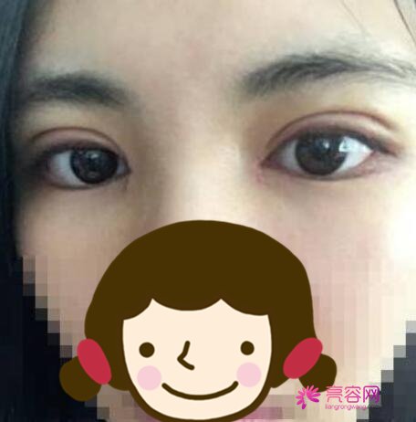 黔东南州人民医院眼科水平怎么样?眼科医生介绍+双眼皮案例分享