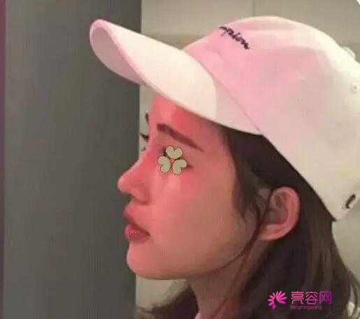 昆明大华整形美容医院怎么样?口碑整形医院+隆鼻手术真人果反馈