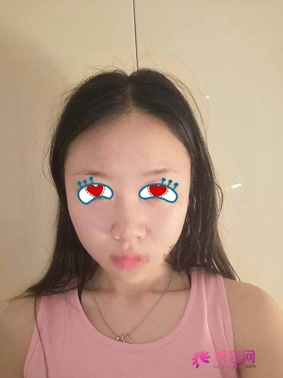 同济冯幼平脂肪填充果好吗?医生综合实力分析+面部脂肪填充案例