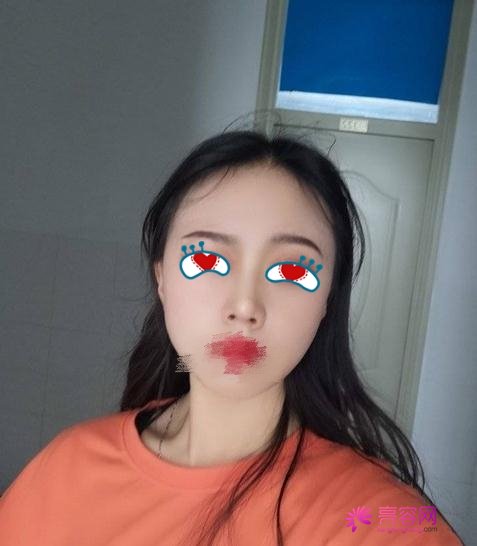 同济冯幼平脂肪填充果好吗?医生综合实力分析+面部脂肪填充案例