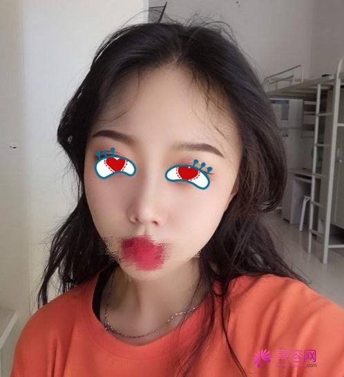 同济冯幼平脂肪填充果好吗?医生综合实力分析+面部脂肪填充案例