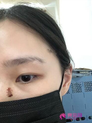 广州市中西医结合医院烧伤整形外科怎么样?医生信息与疤痕修复手术案例