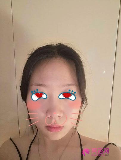 同济冯幼平脂肪填充果好吗?医生综合实力分析+面部脂肪填充案例