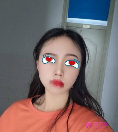 同济冯幼平脂肪填充果好吗?医生综合实力分析+面部脂肪填充案例