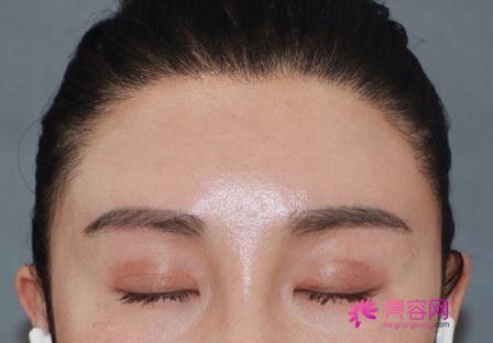 双眼皮修复案例图分享~快来看看果好不好