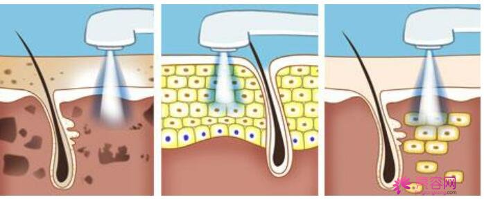 光子嫩肤优势都有那些呢？光子嫩肤都有那些注意事项呢？