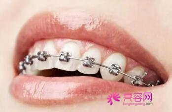 牙齿矫正的较佳年龄是多大呢？牙齿矫正需要注意的事项都有哪些？