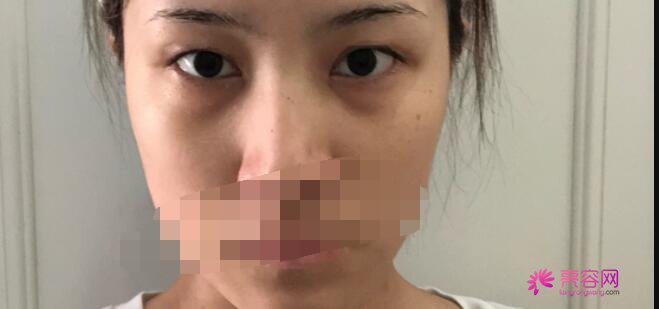 成都军区总医院李先慧医生做双眼皮怎么样?医生口碑评价+双眼皮案例