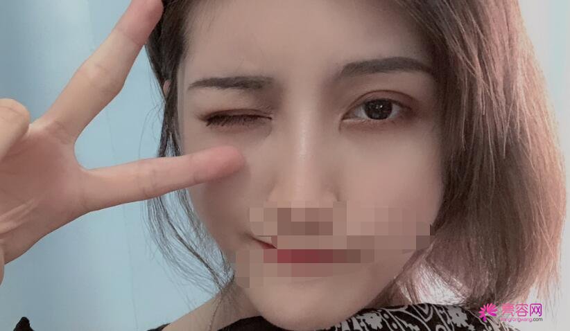 成都军区总医院李先慧医生做双眼皮怎么样?医生口碑评价+双眼皮案例