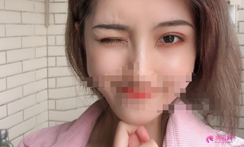 成都军区总医院李先慧医生做双眼皮怎么样?医生口碑评价+双眼皮案例