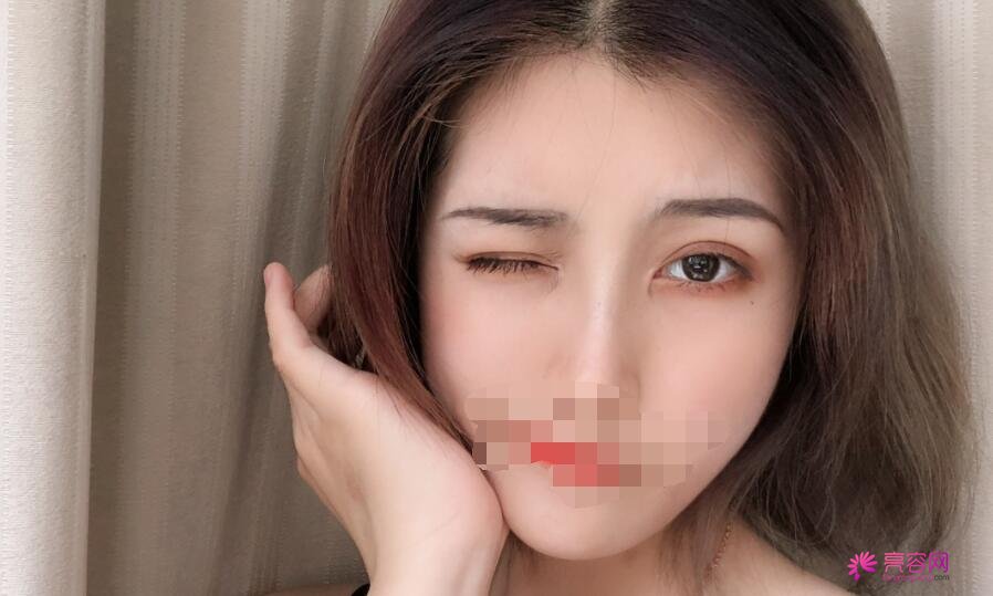 成都军区总医院李先慧医生做双眼皮怎么样?医生口碑评价+双眼皮案例
