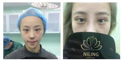 整形效果对比图