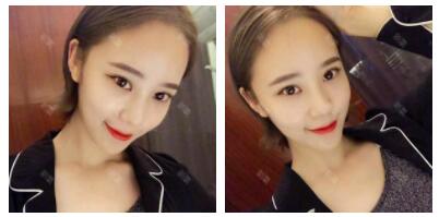 整形效果对比图